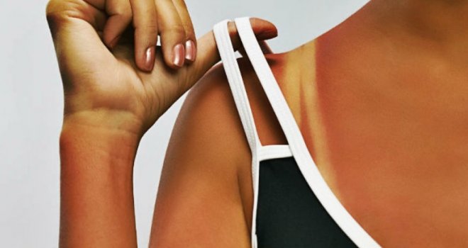 Izgorjeli ste na suncu? Dermatolozi: Odmah uradite…