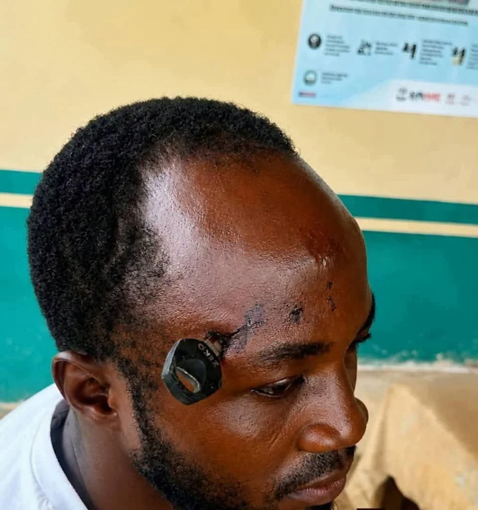 Ghana : Ayant voulu calmer une bagarre, un homme s’est fait planter une clé dans le crâne